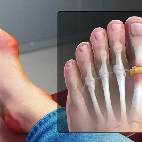 Đắp lá trộn muối chữa gout, nam bệnh nhân mất ngón chân