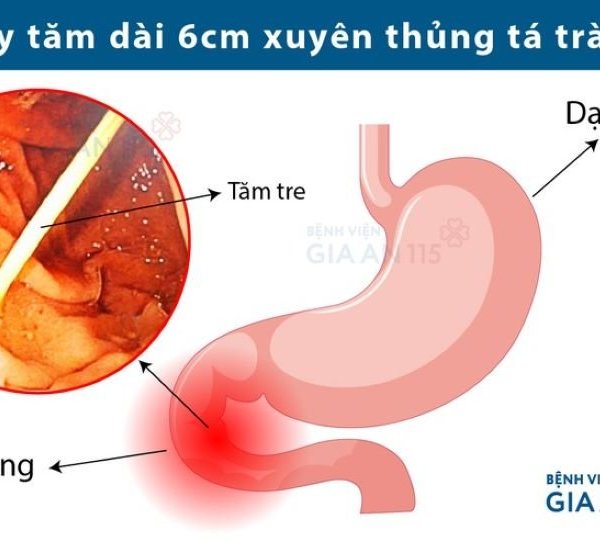 Hoảng hồn bệnh nhân bị tăm đâm thủng ruột mà không hay biết