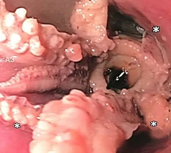 Khó nuốt đi khám, bác sĩ sốc nặng khi thấy thứ trong cổ người đàn ông