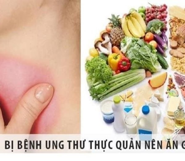 9 dấu hiệu giúp bạn nhận biết ung thư thực quản sớm nhất